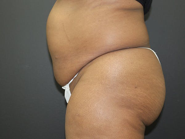 Abdominoplasty Before & After Gallery - Patient 107315659 - Image 5