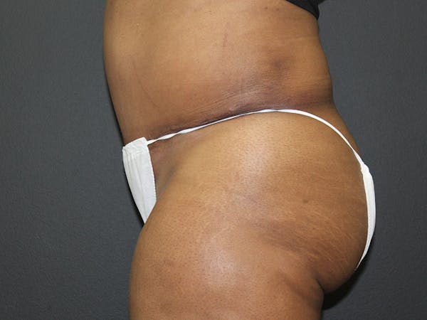 Abdominoplasty Before & After Gallery - Patient 107315659 - Image 6