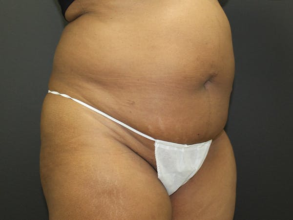 Abdominoplasty Before & After Gallery - Patient 107315659 - Image 7
