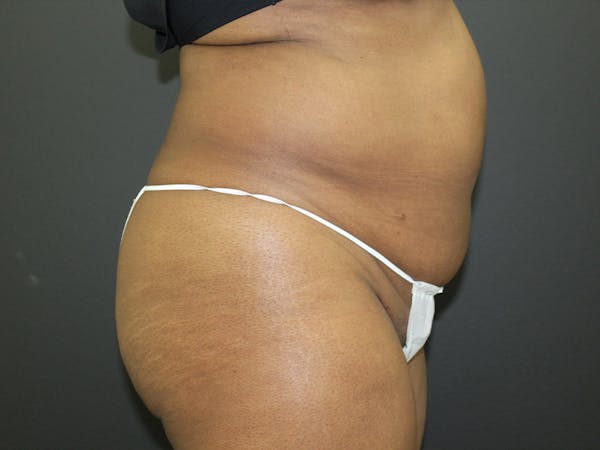 Abdominoplasty Before & After Gallery - Patient 107315659 - Image 9