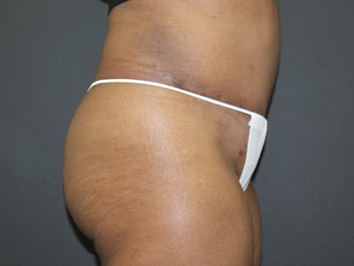 Abdominoplasty Before & After Gallery - Patient 107315659 - Image 10