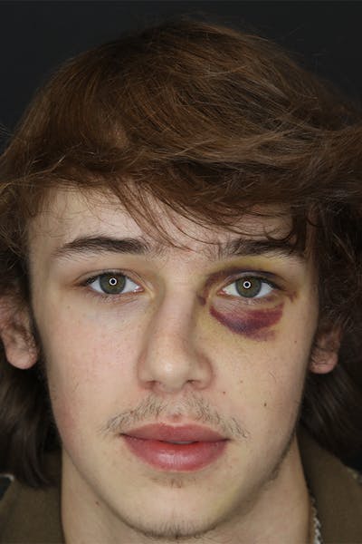 Nasal Reconstruction Before & After Gallery - Patient 109508102 - Image 1