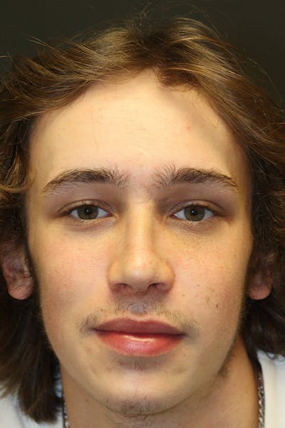 Nasal Reconstruction Before & After Gallery - Patient 109508102 - Image 2
