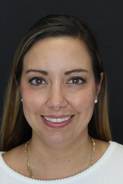 Neck Liposuction Before & After Gallery - Patient 109508143 - Image 1