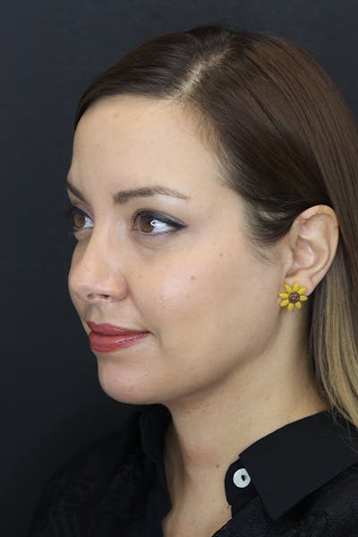 Neck Liposuction Before & After Gallery - Patient 109508143 - Image 4