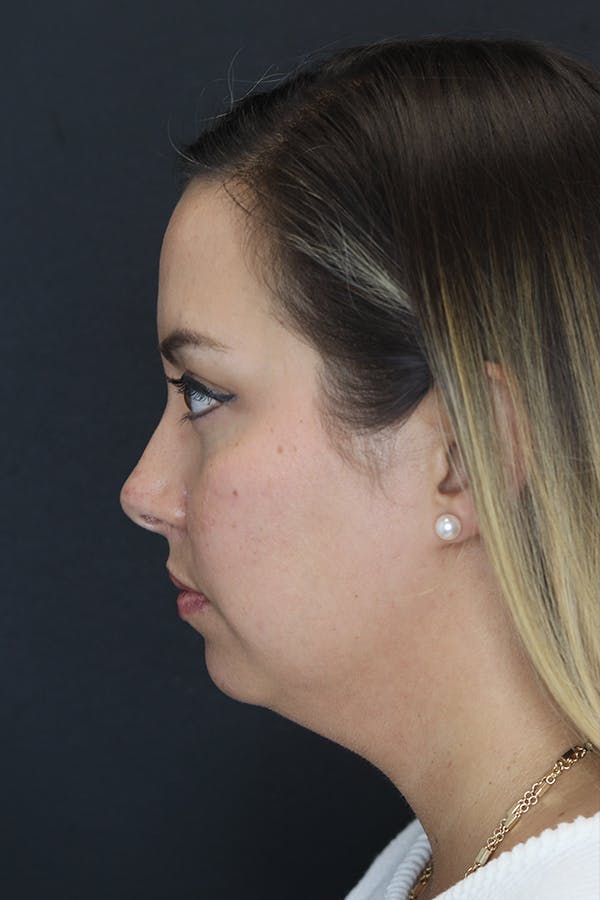 Neck Liposuction Before & After Gallery - Patient 109508143 - Image 5