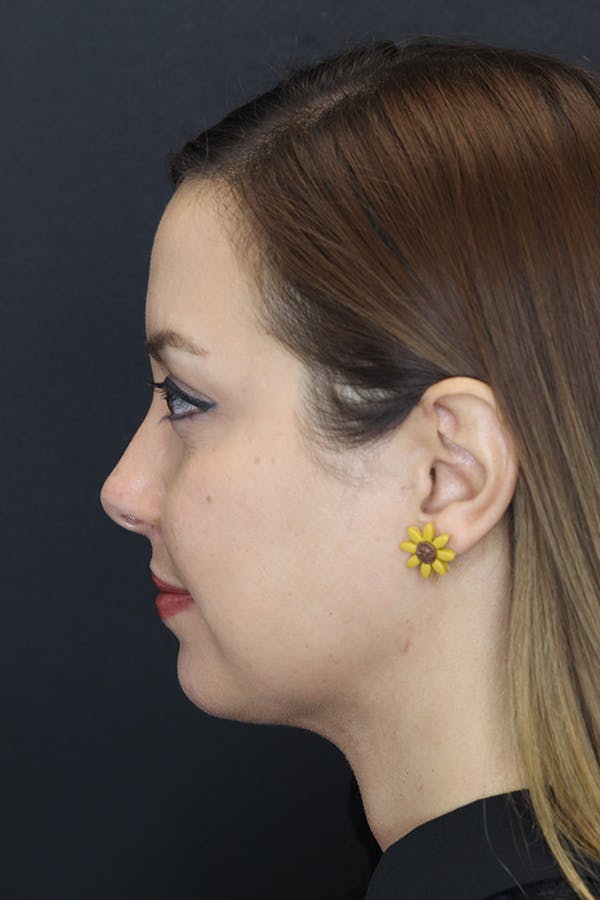 Neck Liposuction Before & After Gallery - Patient 109508143 - Image 6