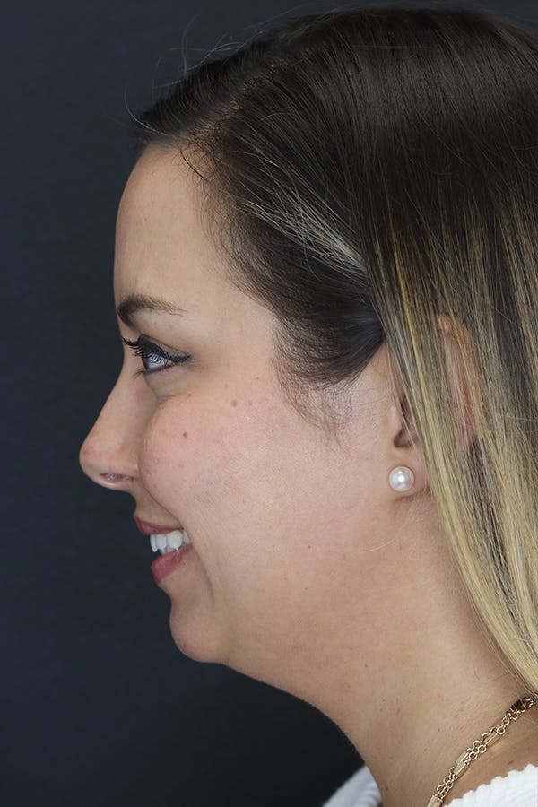 Neck Liposuction Before & After Gallery - Patient 109508143 - Image 7
