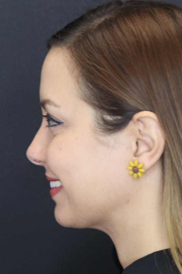 Neck Liposuction Before & After Gallery - Patient 109508143 - Image 8