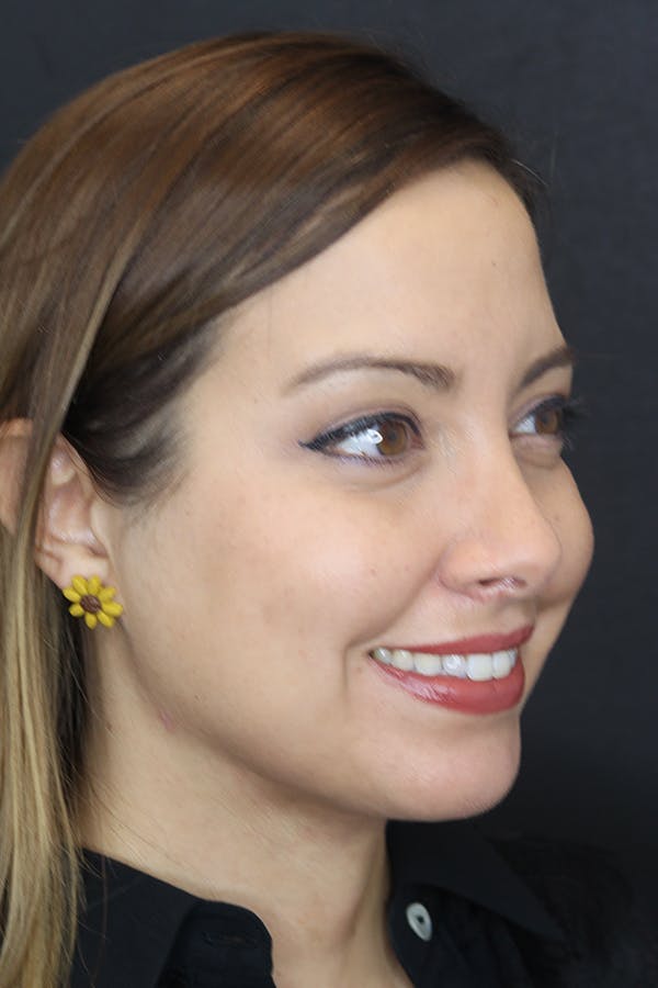 Neck Liposuction Before & After Gallery - Patient 109508143 - Image 10