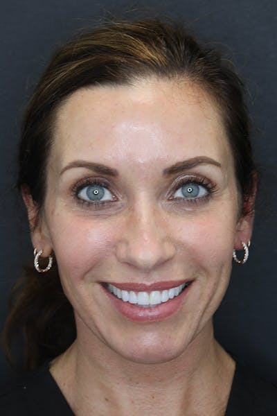 Rhinoplasty Before & After Gallery - Patient 109508149 - Image 1