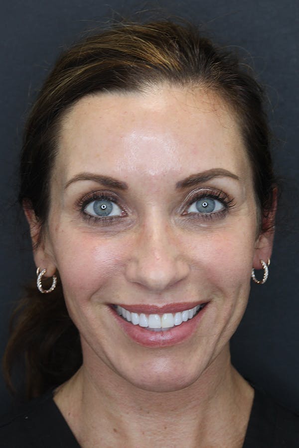 Rhinoplasty Before & After Gallery - Patient 109508149 - Image 1