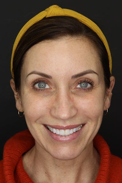 Rhinoplasty Before & After Gallery - Patient 109508149 - Image 2