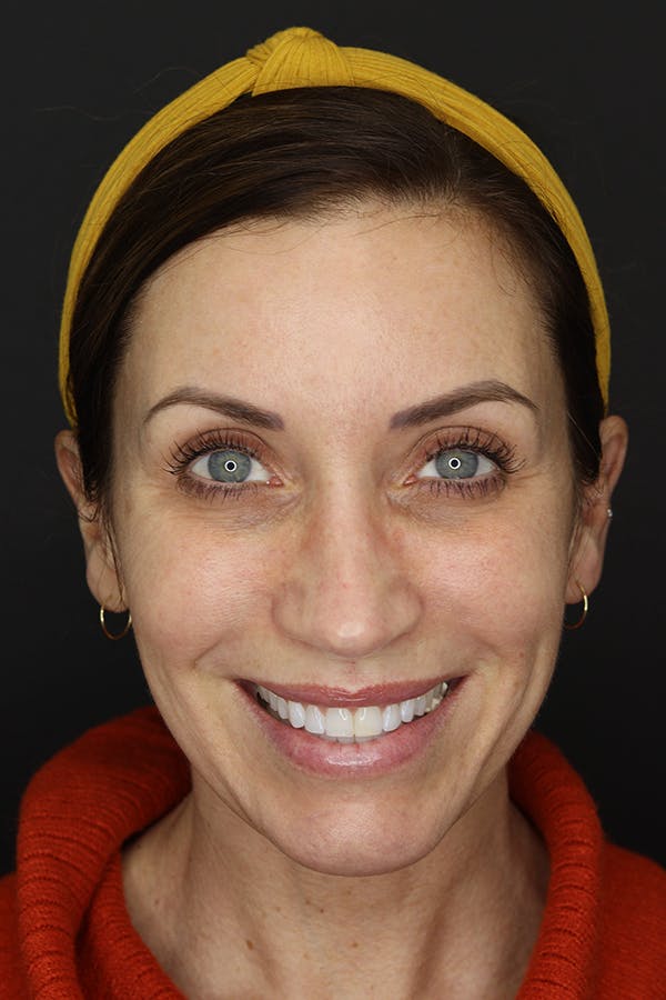 Rhinoplasty Before & After Gallery - Patient 109508149 - Image 2
