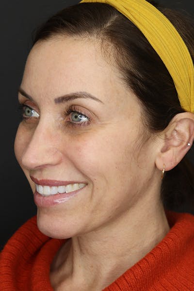 Rhinoplasty Before & After Gallery - Patient 109508149 - Image 4