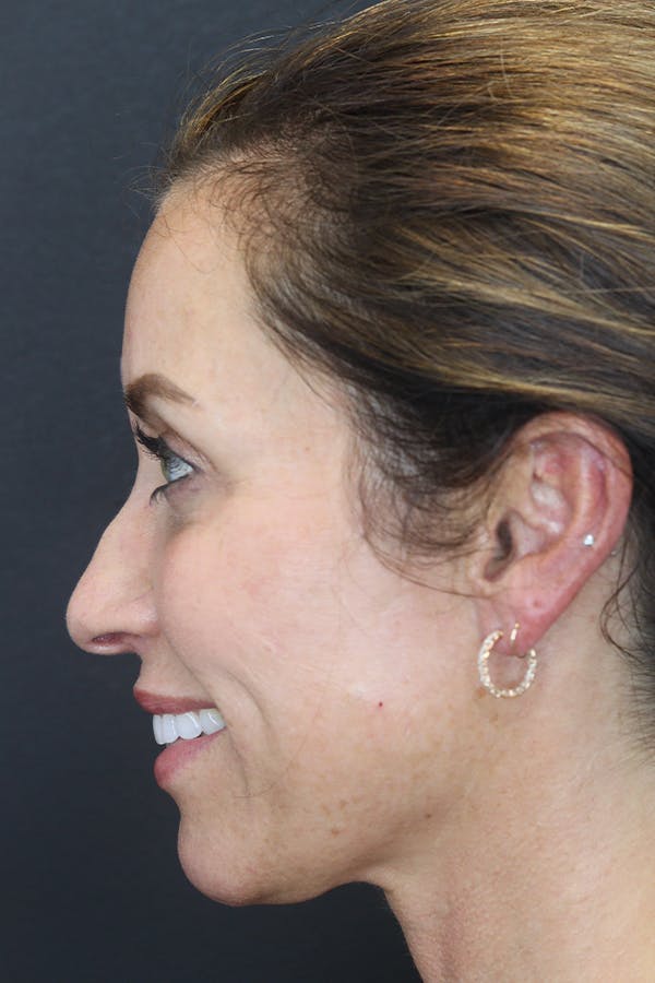 Rhinoplasty Before & After Gallery - Patient 109508149 - Image 5