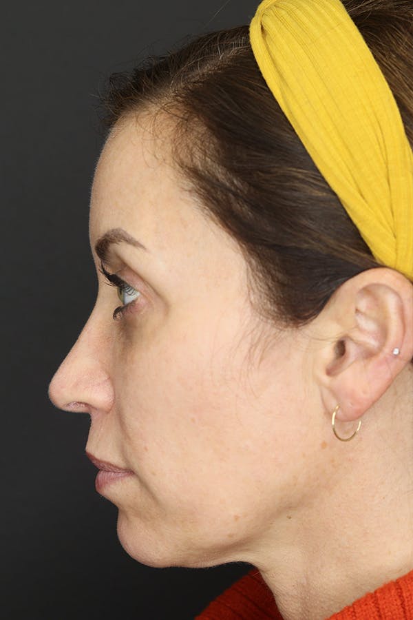 Rhinoplasty Before & After Gallery - Patient 109508149 - Image 6