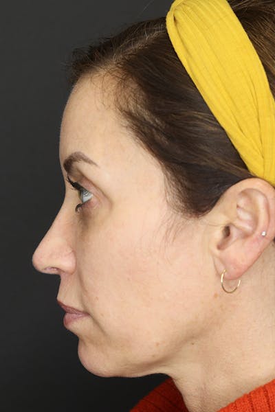 Rhinoplasty Before & After Gallery - Patient 109508149 - Image 6