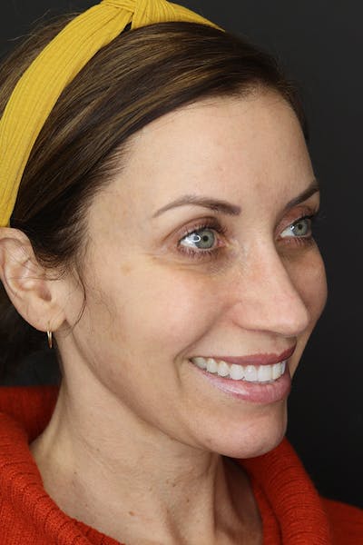 Rhinoplasty Before & After Gallery - Patient 109508149 - Image 8