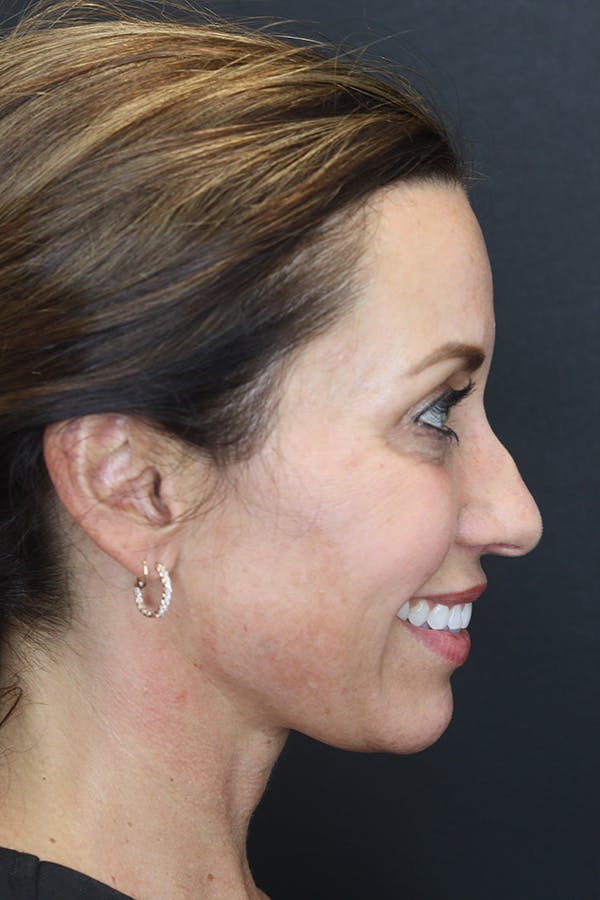 Rhinoplasty Before & After Gallery - Patient 109508149 - Image 9