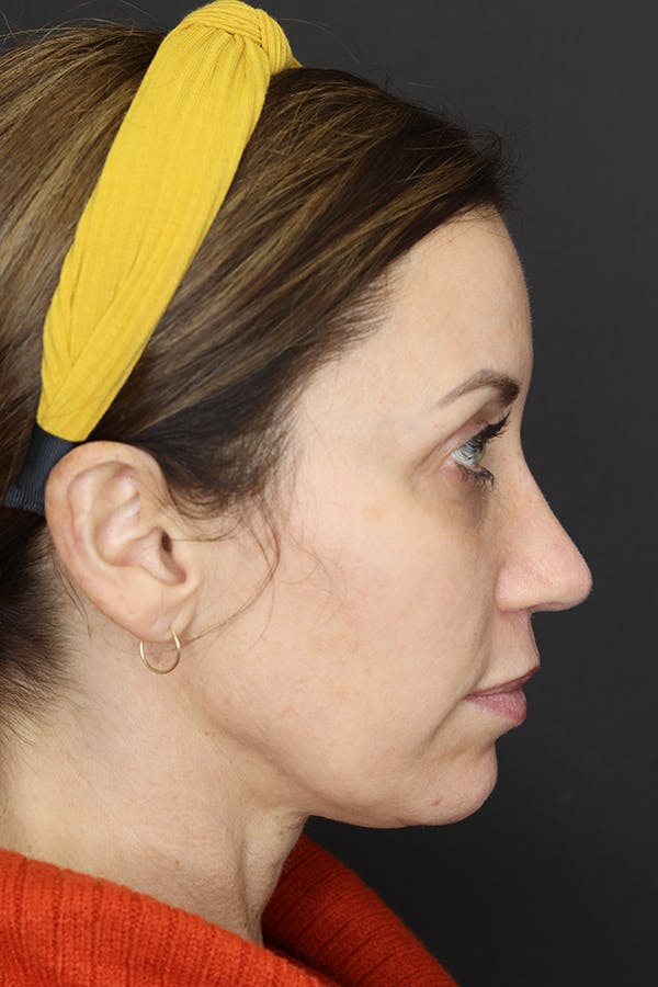 Rhinoplasty Before & After Gallery - Patient 109508149 - Image 10