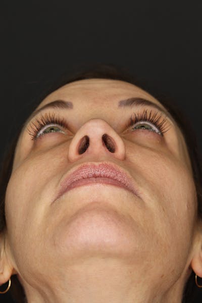 Rhinoplasty Before & After Gallery - Patient 109508149 - Image 12