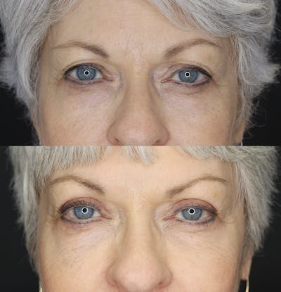 Eyelid Surgery Before & After Gallery - Patient 109508157 - Image 1