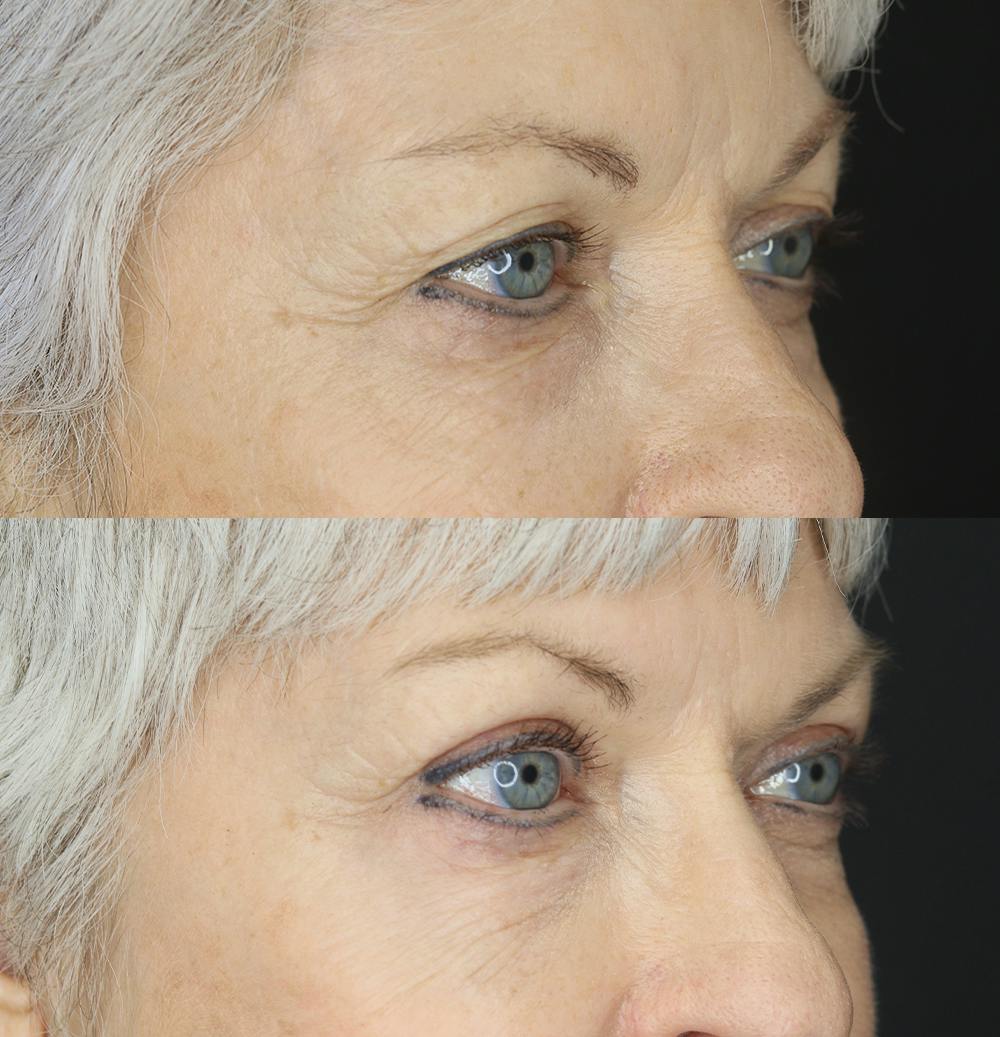 Eyelid Surgery Before & After Gallery - Patient 109508157 - Image 3
