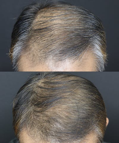 Hair Restoration  Before & After Gallery - Patient 109508162 - Image 1