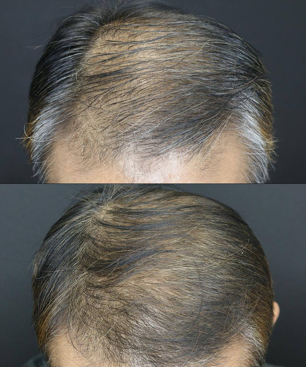Hair Restoration  Before & After Gallery - Patient 109508162 - Image 1
