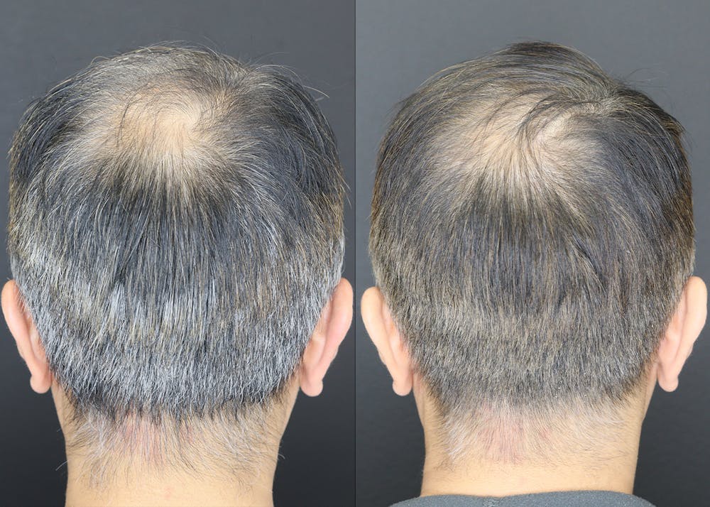 Hair Restoration  Before & After Gallery - Patient 109508162 - Image 2