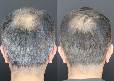 Hair Restoration  Before & After Gallery - Patient 109508162 - Image 2