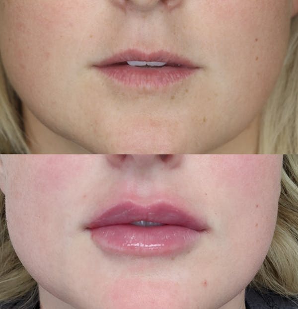 Lip Augmentation Before & After Gallery - Patient 109508167 - Image 1