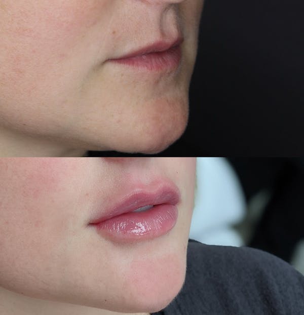 Lip Augmentation Before & After Gallery - Patient 109508167 - Image 2