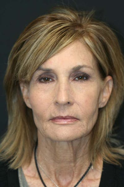 Facelift Before & After Gallery - Patient 121417299 - Image 1