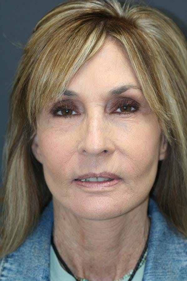 Facelift Before & After Gallery - Patient 121417299 - Image 2