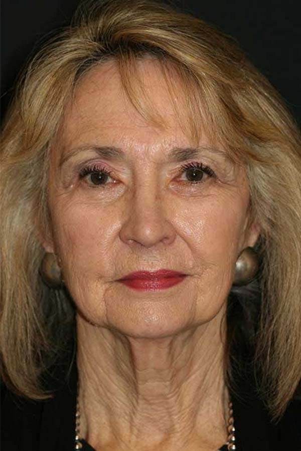 Facelift Before & After Gallery - Patient 121417300 - Image 1