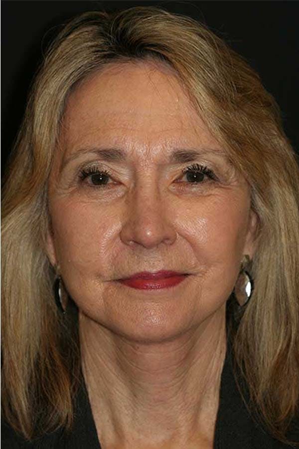 Facelift Before & After Gallery - Patient 121417300 - Image 2