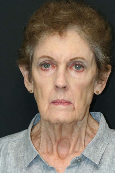 Facelift Before & After Gallery - Patient 121417301 - Image 1