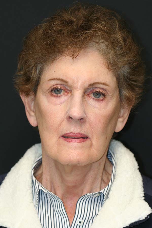 Facelift Before & After Gallery - Patient 121417301 - Image 2