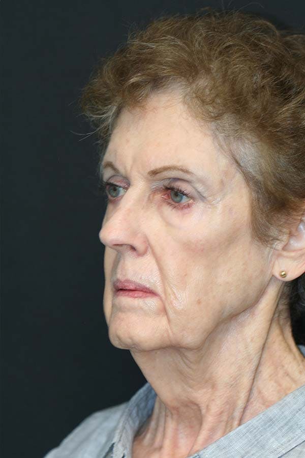 Facelift Before & After Gallery - Patient 121417301 - Image 3