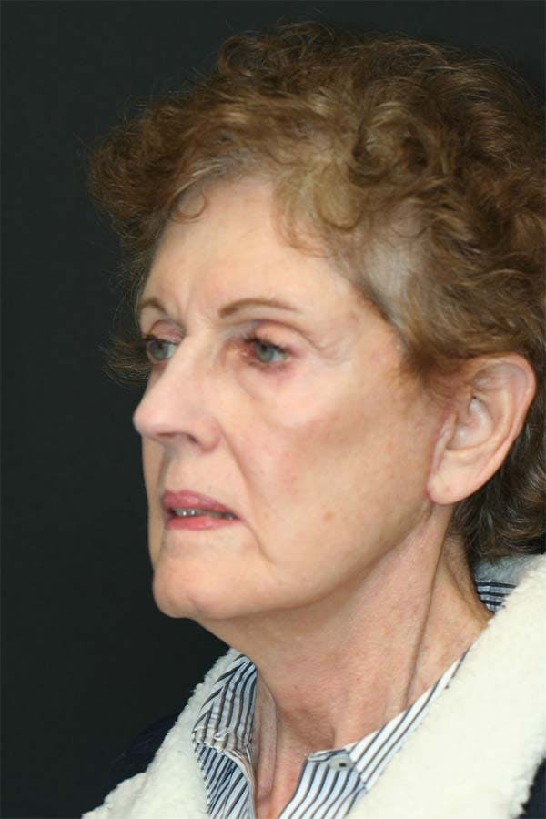 Facelift Before & After Gallery - Patient 121417301 - Image 4