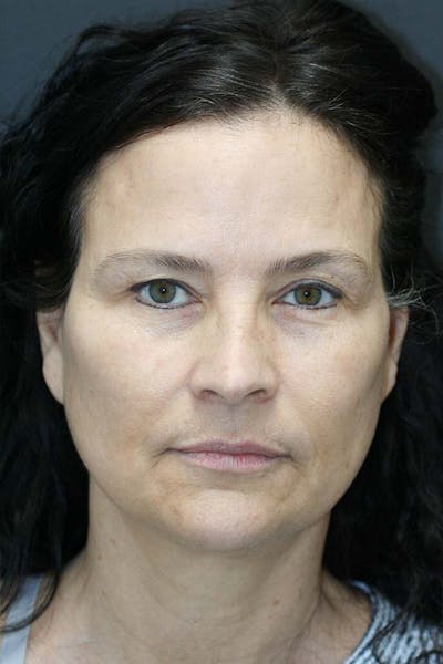 Facelift Before & After Gallery - Patient 121417302 - Image 1