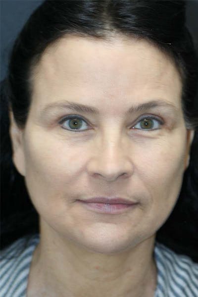 Facelift Before & After Gallery - Patient 121417302 - Image 2
