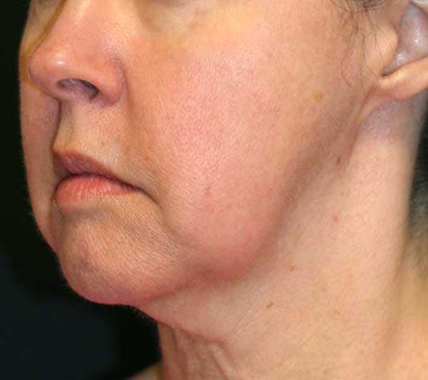 Facelift Before & After Gallery - Patient 121417303 - Image 1