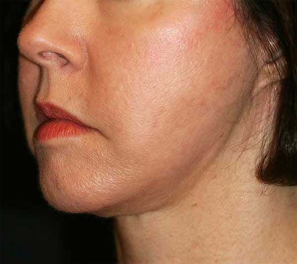 Facelift Before & After Gallery - Patient 121417303 - Image 2