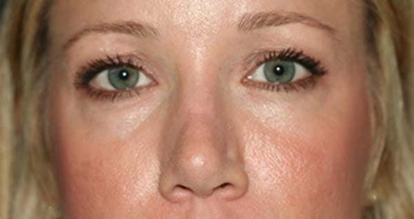 Lower Blepharoplasty Gallery - Patient 121417404 - Image 1