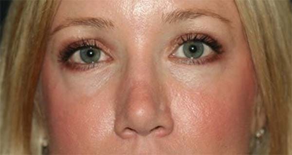 Lower Blepharoplasty Before & After Gallery - Patient 121417404 - Image 2