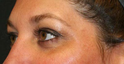 Upper Blepharoplasty Before & After Gallery - Patient 121417476 - Image 1