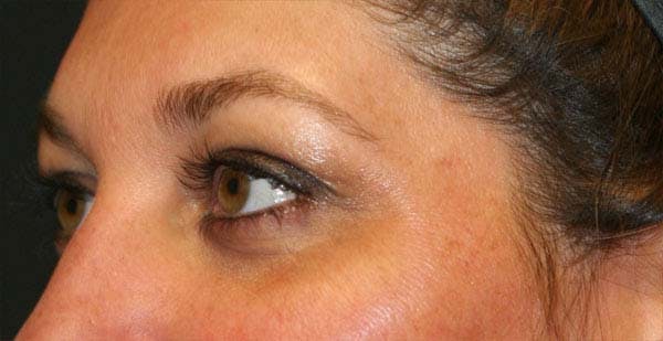 Upper Blepharoplasty Before & After Gallery - Patient 121417476 - Image 1